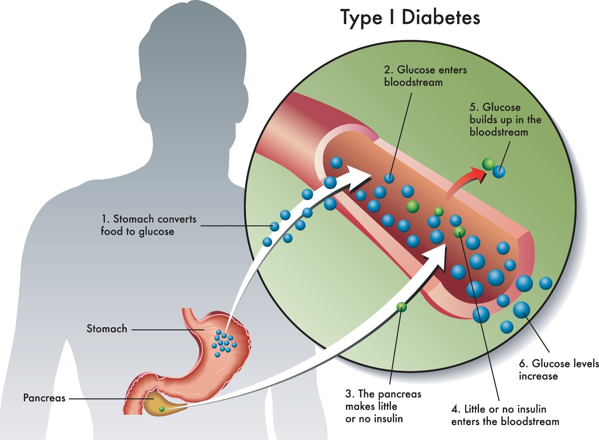 Revue : Thérapies nouvelles et émergentes dans le diabète sucré de type 1. Crédit d'image : rob9000/Shutterstock