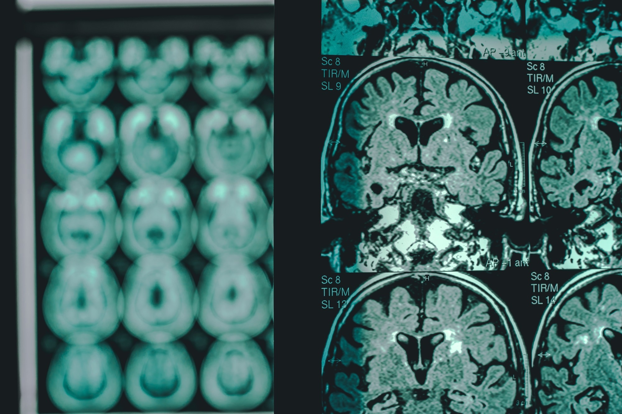 Étude : L'hyperglycosylation est un moteur métabolique de la maladie d'Alzheimer. Crédit d'image : Atthapon Raksthaput/Shutterstock