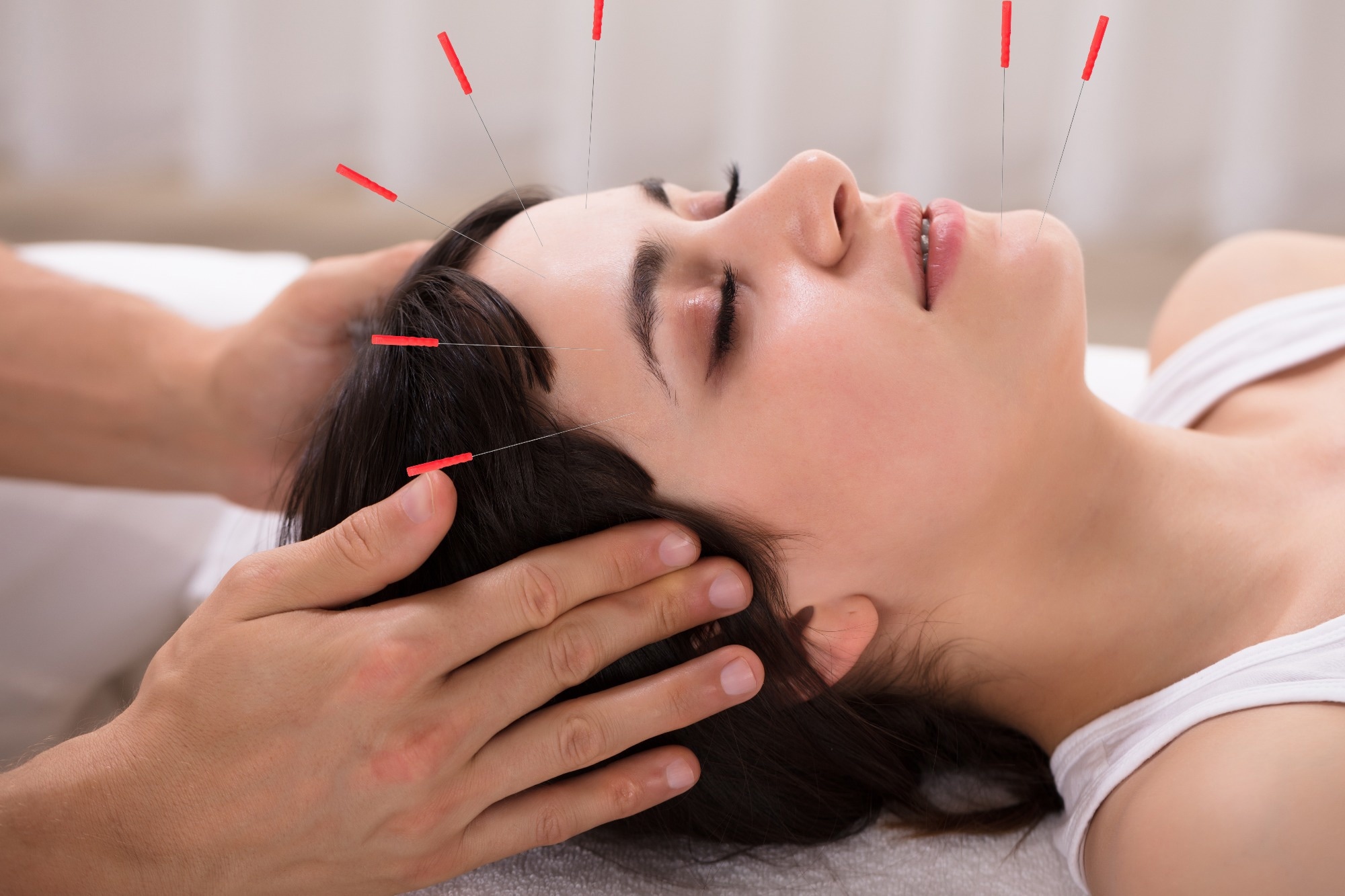 Jeune femme d&eacute;tendue recevant un traitement d'acupuncture