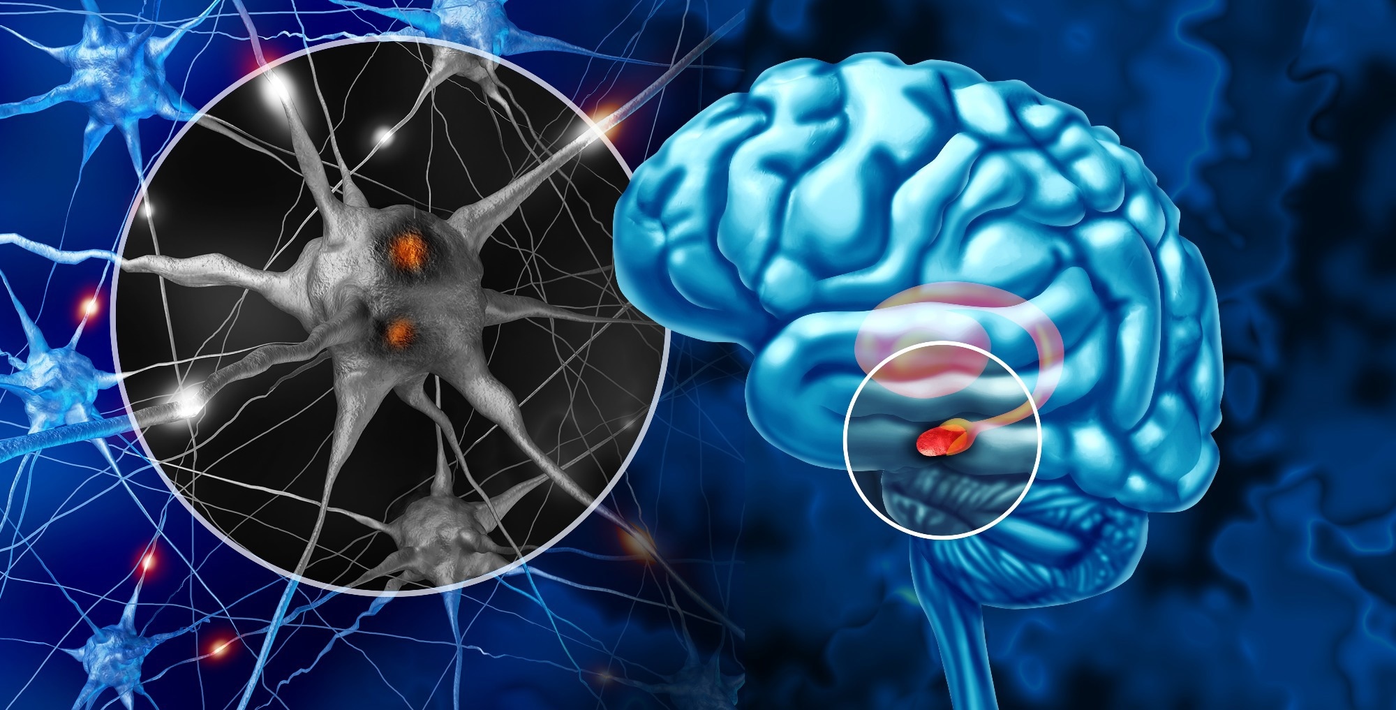 Étude : Sommeil et maladie de Parkinson : une étude basée sur la population de la cohorte CHARLS.